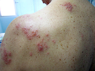 herpes zoster_2