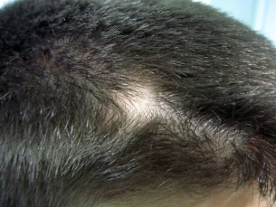 Алопеция (Alopecia areata)