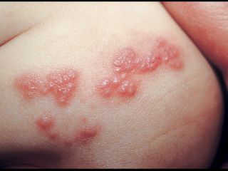 varicella-zoster-virus-infection-cluster-21